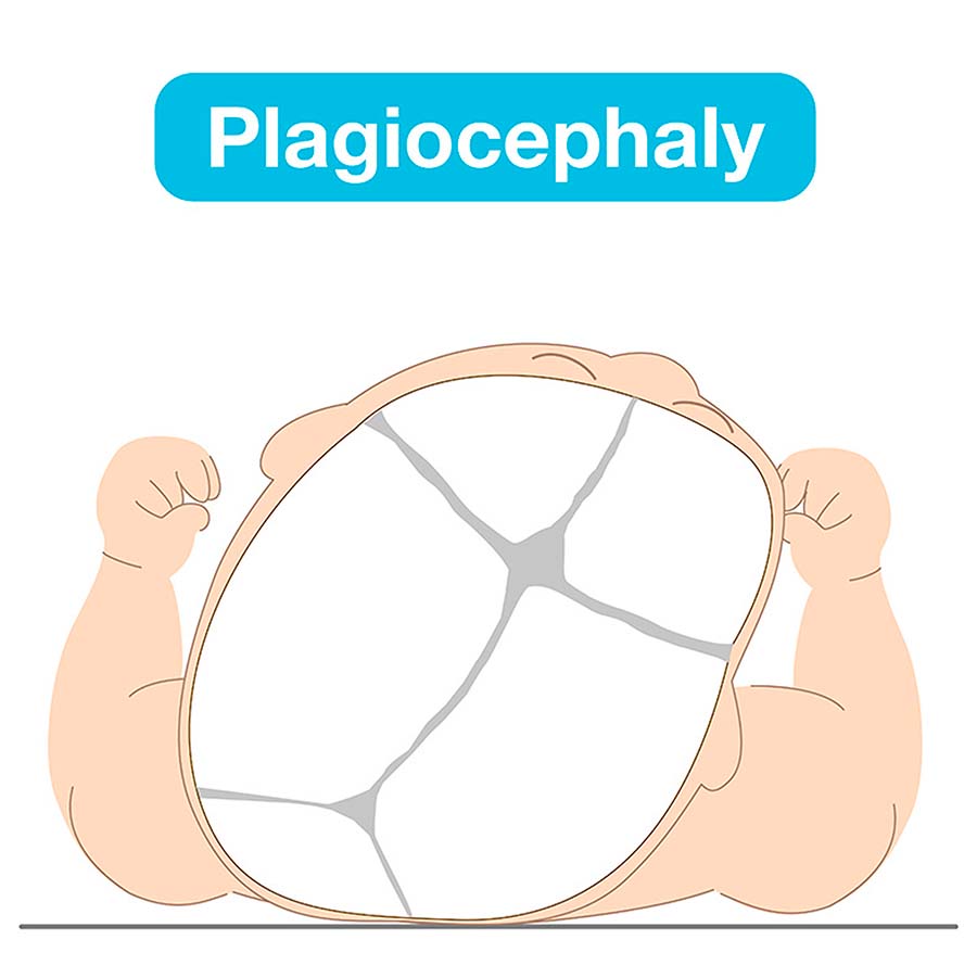 schéma plagiocéphalie bébé déformation crânienne nourrisson