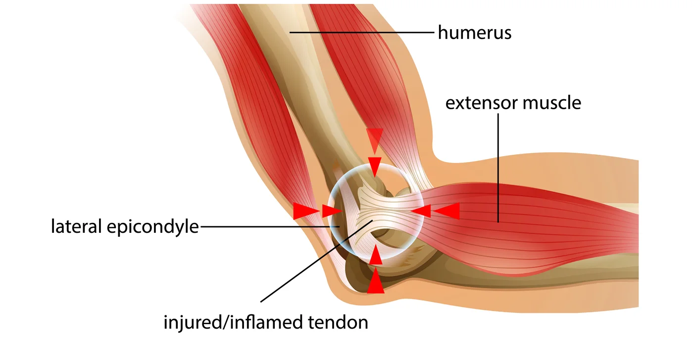 Schéma anatomique de l’épicondylite latérale et des tendons extenseurs du coude